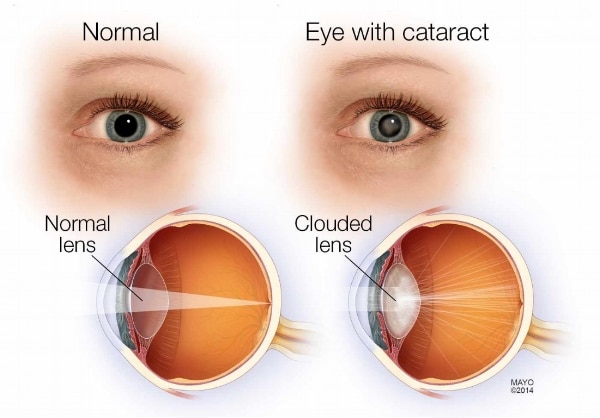 ophthalmic Early Detection