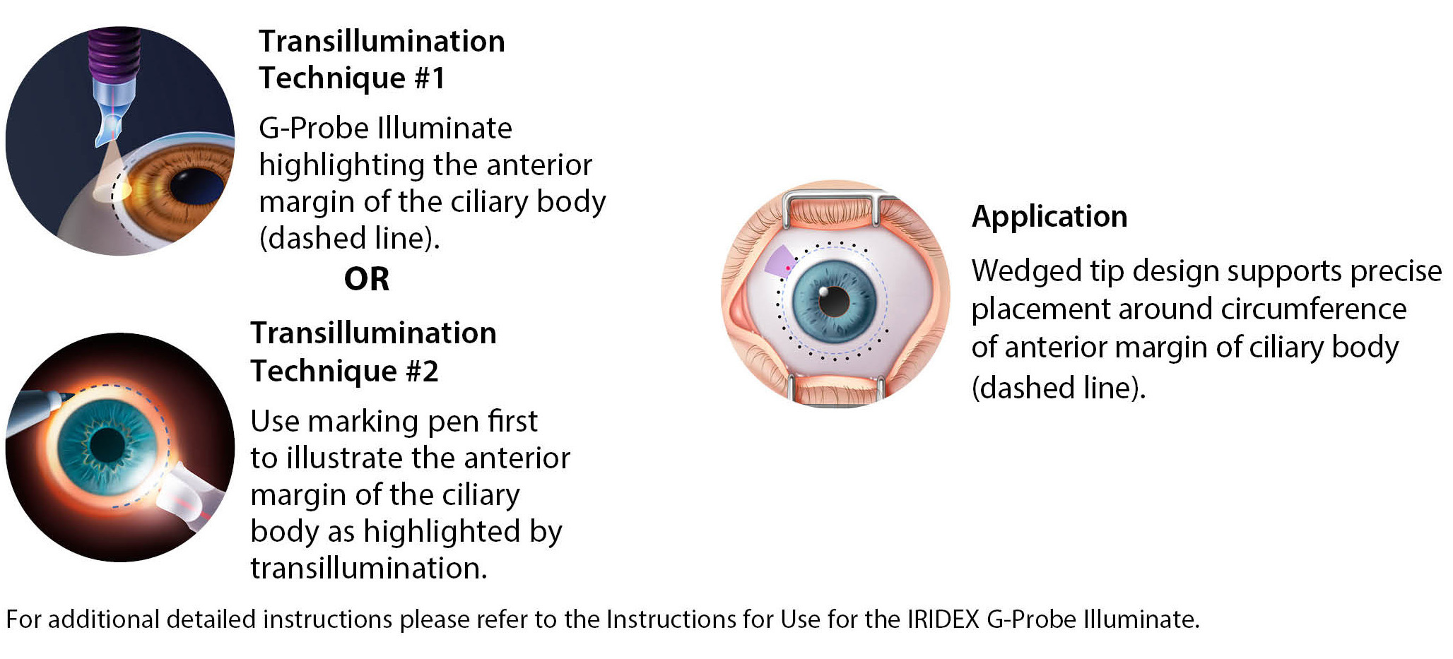 Probe-treatment-techniques-G-Probe-Illuminate