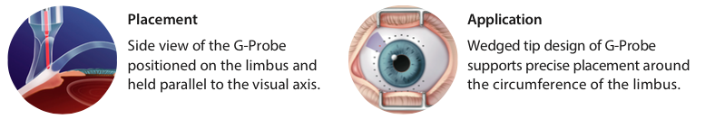 g-probe-treatment-technique