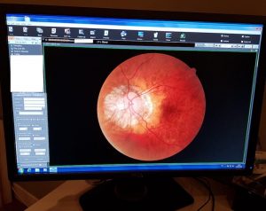 Nidek-RS-330-For-Sale-12