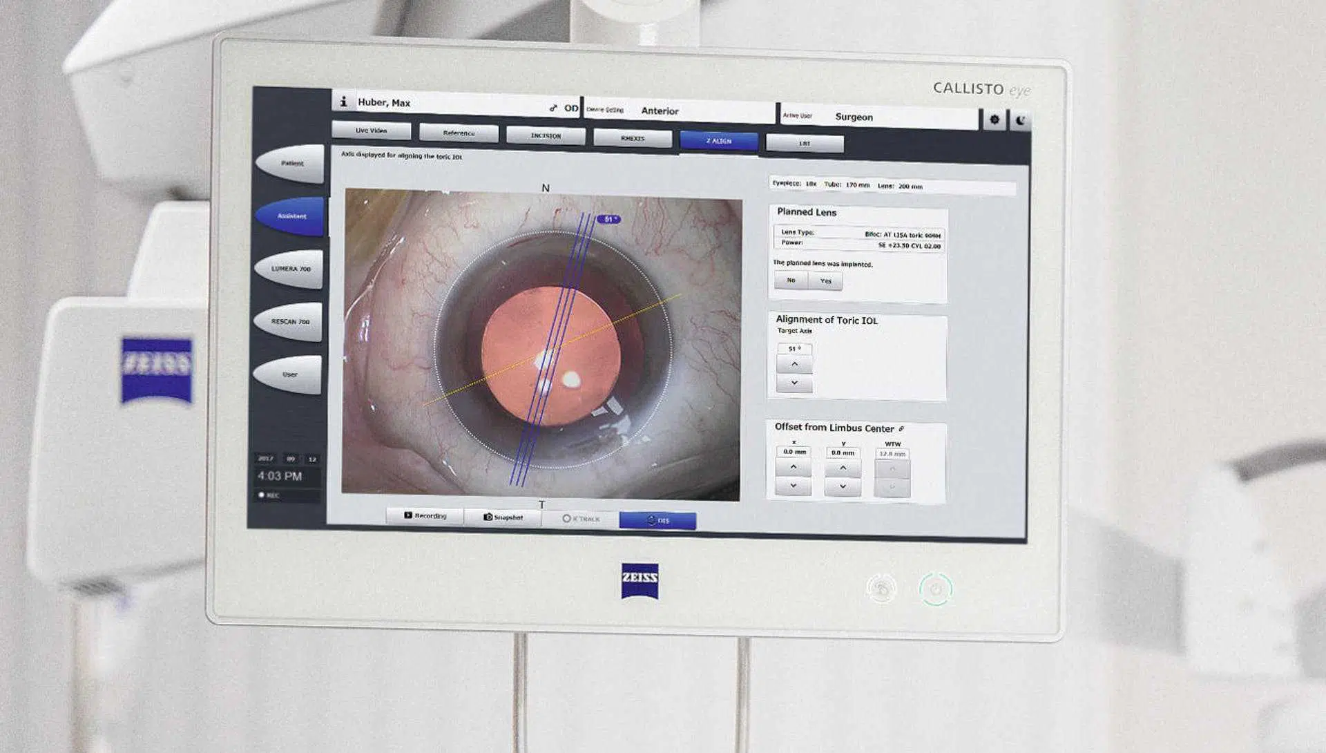 Precise-IOL-alignment