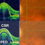 Central-Serous-Retinopathy