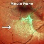 Macular-Pucker