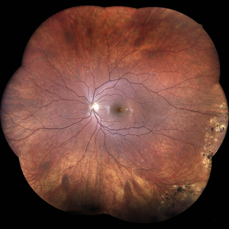 iCare-EIDON_Laser-Treatment